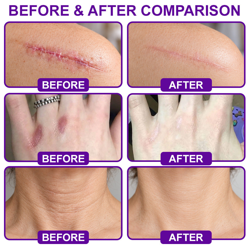 🆙🆙🆙Trilumia® Advanced Silicone Scar Tape🩹