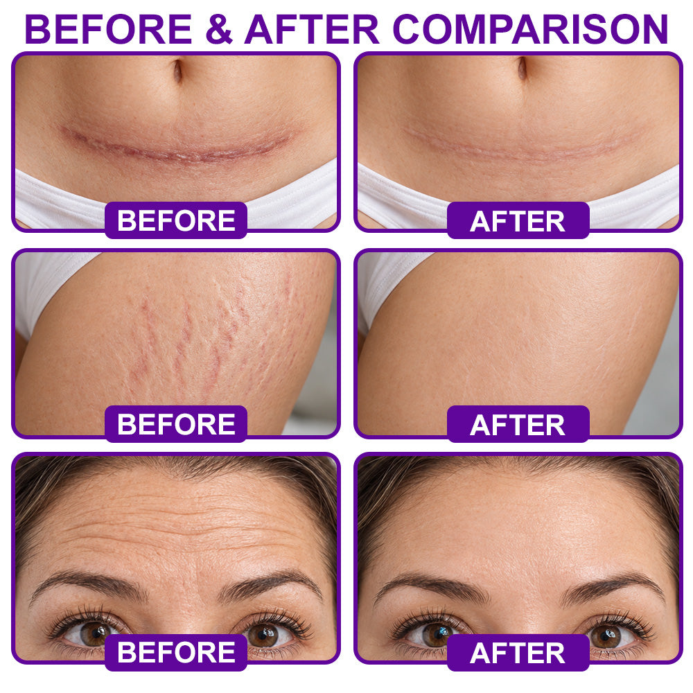 🆙🆙🆙Trilumia® Advanced Silicone Scar Tape🩹